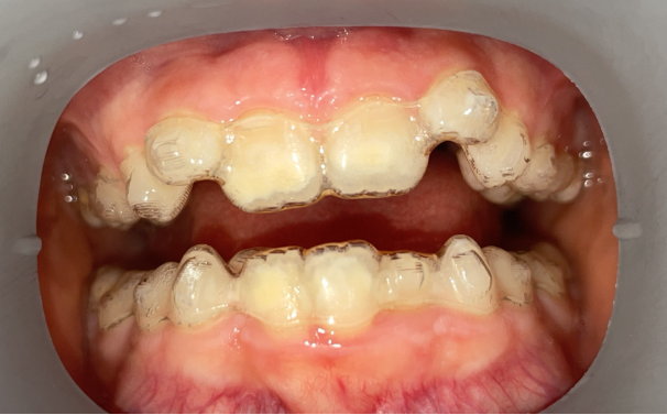 Phase 1 Orthodontic Treatment with Invisalign for children in Buffalo Grove, IL